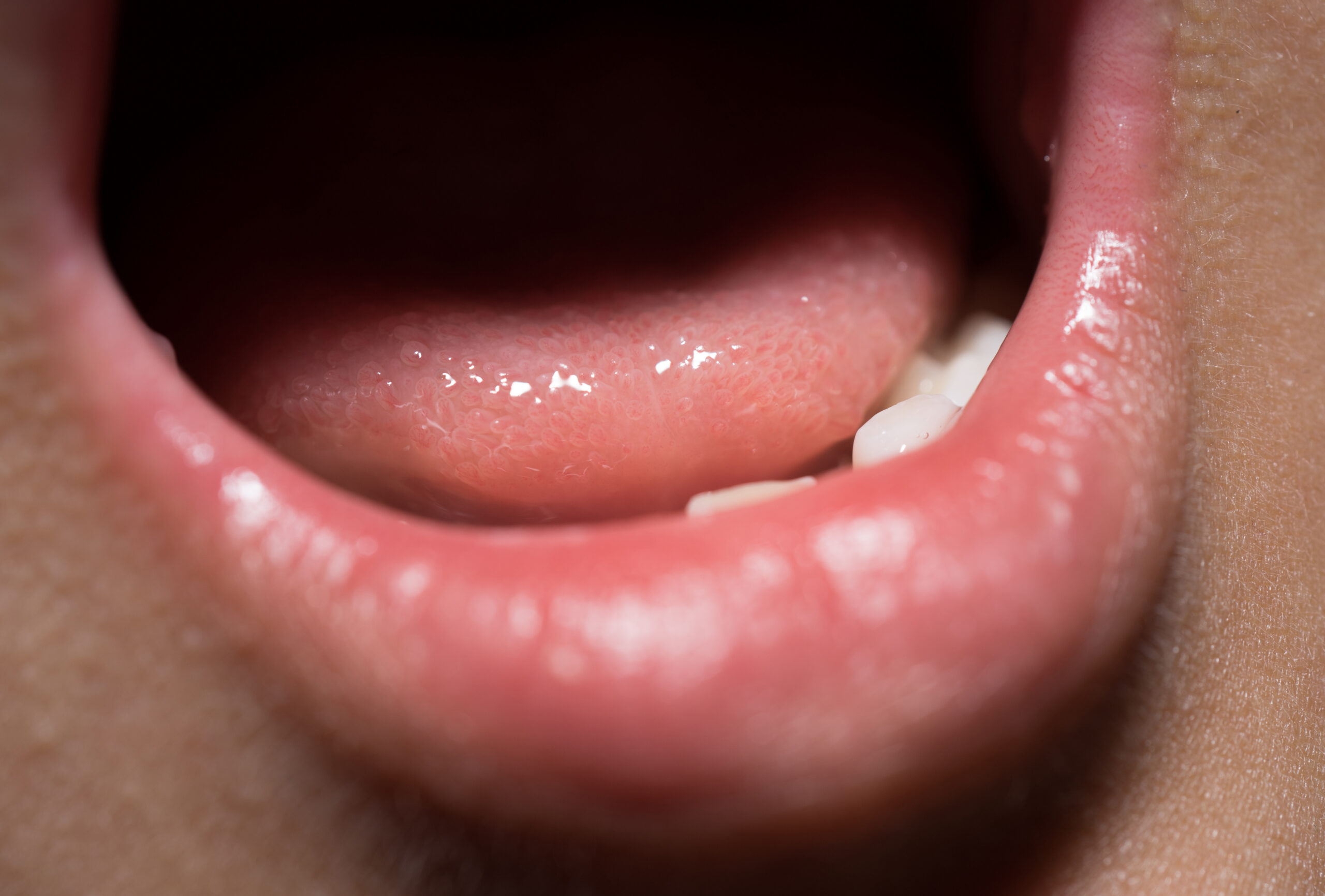 Owrzodzenie języka jako wczesny objaw infekcji COVID-19