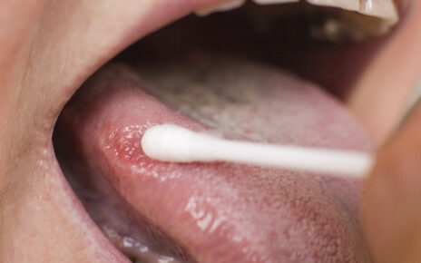Rak języka najczęstszym nowotworem jamy ustnej