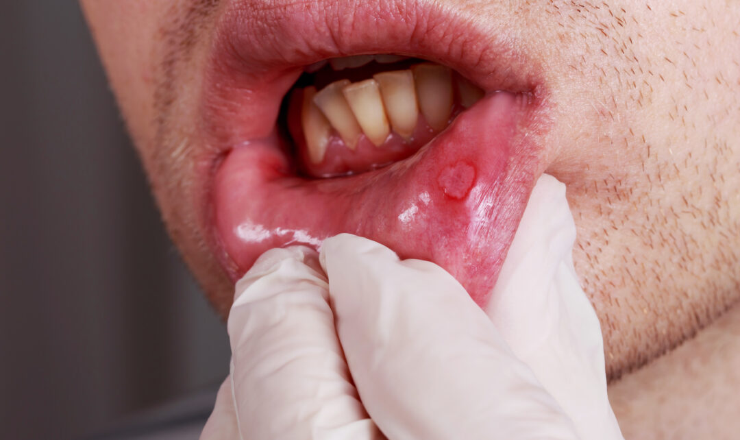 Badanie: ponad 80 proc. ozdrowieńców z uszkodzeniem jamy ustnej