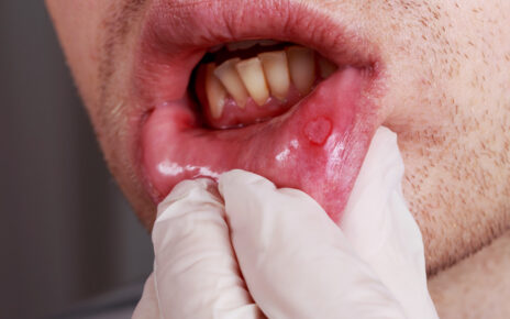 Badanie: ponad 80 proc. ozdrowieńców z uszkodzeniem jamy ustnej