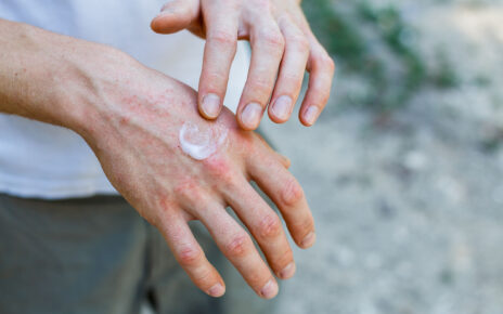 Coraz więcej osób ze stanami zapalnymi skóry wywołanymi restrykcyjną higieną rąk